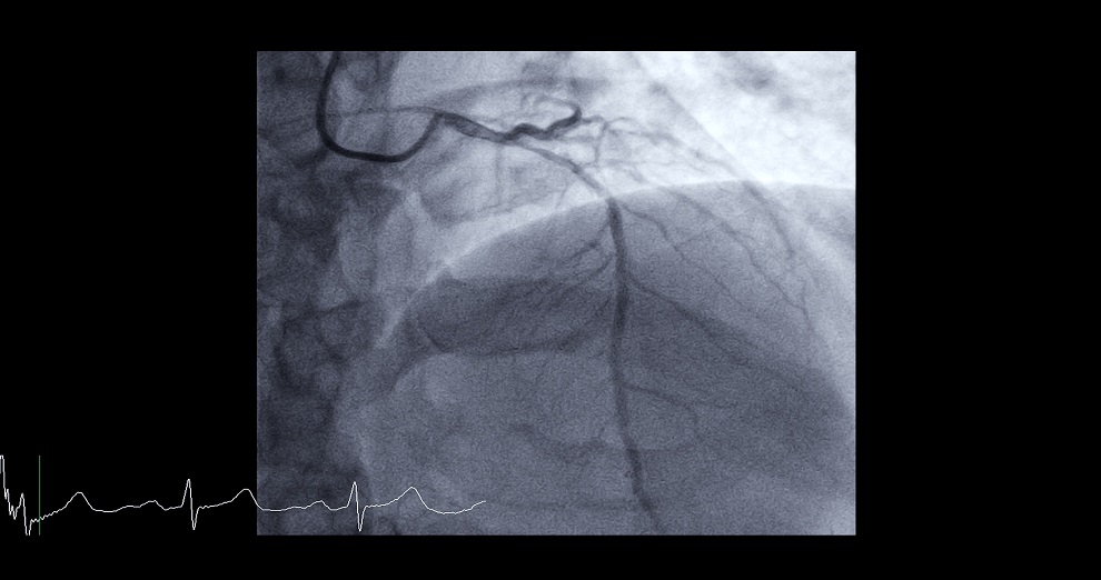 Imagen: Angiografía coronaria por TC para diagnosticar la enfermedad de la arteria coronaria ofrece ventajas sobre otras pruebas de diagnóstico (foto cortesía de 123RF)